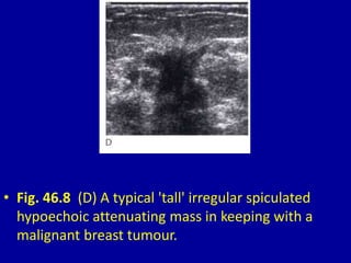 • Fig. 46.8 (D) A typical 'tall' irregular spiculated
hypoechoic attenuating mass in keeping with a
malignant breast tumour.
 