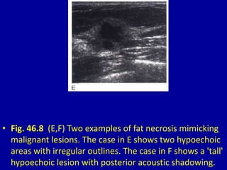 • Fig. 46.8 (E,F) Two examples of fat necrosis mimicking
malignant lesions. The case in E shows two hypoechoic
areas with irregular outlines. The case in F shows a 'tall'
hypoechoic lesion with posterior acoustic shadowing.
 