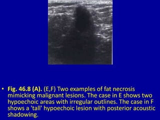 • Fig. 46.8 (A). (E,F) Two examples of fat necrosis
mimicking malignant lesions. The case in E shows two
hypoechoic areas with irregular outlines. The case in F
shows a 'tall' hypoechoic lesion with posterior acoustic
shadowing.
 