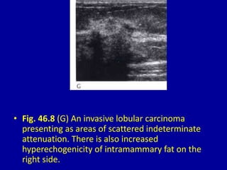 • Fig. 46.8 (G) An invasive lobular carcinoma
presenting as areas of scattered indeterminate
attenuation. There is also increased
hyperechogenicity of intramammary fat on the
right side.
 