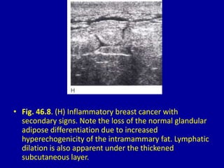 • Fig. 46.8. (H) Inflammatory breast cancer with
secondary signs. Note the loss of the normal glandular
adipose differentiation due to increased
hyperechogenicity of the intramammary fat. Lymphatic
dilation is also apparent under the thickened
subcutaneous layer.
 
