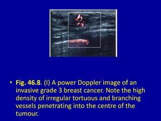 • Fig. 46.8. (I) A power Doppler image of an
invasive grade 3 breast cancer. Note the high
density of irregular tortuous and branching
vessels penetrating into the centre of the
tumour.
 