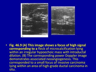 • Fig. 46.9 (A) This image shows a focus of high signal
corresponding to a fleck of microcalcification lying
within an irregular hypoechoic mass with intraductal
dilation. (B) The corresponding power Doppler image
demonstrates associated neoangiogenesis. This
corresponded to a small focus of invasive carcinoma
lying within an area of high-grade ductal carcinoma in
situ.
 