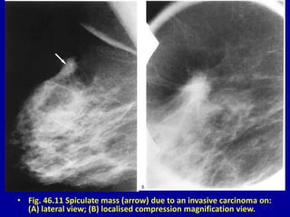 • Fig. 46.11 Spiculate mass (arrow) due to an invasive carcinoma on:
(A) lateral view; (B) localised compression magnification view.
 