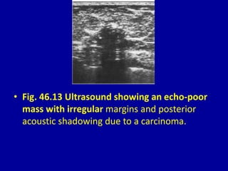 • Fig. 46.13 Ultrasound showing an echo-poor
mass with irregular margins and posterior
acoustic shadowing due to a carcinoma.
 