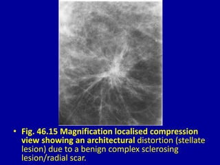• Fig. 46.15 Magnification localised compression
view showing an architectural distortion (stellate
lesion) due to a benign complex sclerosing
lesion/radial scar.
 