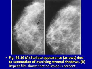 • Fig. 46.16 (A) Stellate appearance (arrows) due
to summation of overlying stromal shadows. (B)
Repeat film shows that no lesion is present.
 