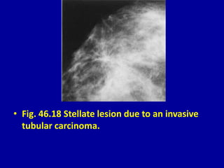 • Fig. 46.18 Stellate lesion due to an invasive
tubular carcinoma.
 