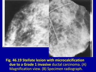 Fig. 46.19 Stellate lesion with microcalcification
due to a Grade 1 invasive ductal carcinoma. (A)
Magnification view. (B) Specimen radiograph.
 