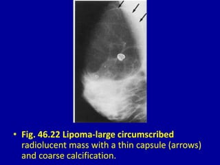 • Fig. 46.22 Lipoma-large circumscribed
radiolucent mass with a thin capsule (arrows)
and coarse calcification.
 