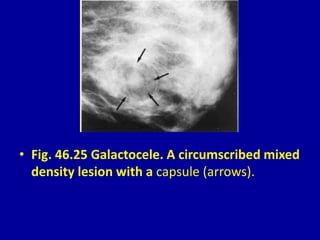 • Fig. 46.25 Galactocele. A circumscribed mixed
density lesion with a capsule (arrows).
 