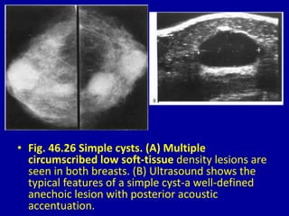 • Fig. 46.26 Simple cysts. (A) Multiple
circumscribed low soft-tissue density lesions are
seen in both breasts. (B) Ultrasound shows the
typical features of a simple cyst-a well-defined
anechoic lesion with posterior acoustic
accentuation.
 