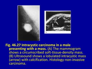 Fig. 46.27 Intracystic carcinoma in a male
presenting with a mass. (A) The mammogram
shows a circumscribed soft-tissue-density mass.
(B) Ultrasound shows a lobulated intracystic mass
(arrow) with calcification. Histology-non-invasive
carcinoma.
 