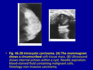 • Fig. 46.28 Intracystic carcinoma. (A) The mammogram
shows a circumscribed soft-tissue mass. (B) Ultrasound
shows internal echoes within a cyst. Needle aspiration-
blood-stained fluid containing malignant cells.
Histology-non-invasive carcinoma.
 