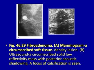 • Fig. 46.29 Fibroadenoma. (A) Mammogram-a
circumscribed soft tissue- density lesion. (B)
Ultrasound-a circumscribed solid low
reflectivity mass with posterior acoustic
shadowing. A focus of calcification is seen.
 