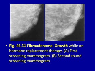 • Fig. 46.31 Fibroadenoma. Growth while on
hormone replacement therapy. (A) First
screening mammogram. (B) Second round
screening mammogram.
 