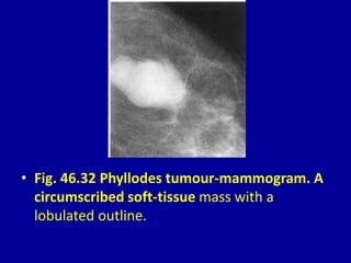 • Fig. 46.32 Phyllodes tumour-mammogram. A
circumscribed soft-tissue mass with a
lobulated outline.
 