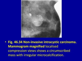 • Fig. 46.34 Non-invasive intracystic carcinoma.
Mammogram magnified localised
compression views shows a circumscribed
mass with irregular microcalcification.
 