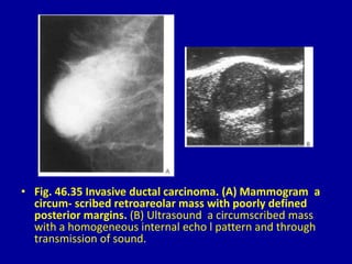 • Fig. 46.35 Invasive ductal carcinoma. (A) Mammogram a
circum- scribed retroareolar mass with poorly defined
posterior margins. (B) Ultrasound a circumscribed mass
with a homogeneous internal echo l pattern and through
transmission of sound.
 