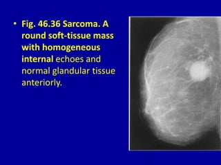 • Fig. 46.36 Sarcoma. A
round soft-tissue mass
with homogeneous
internal echoes and
normal glandular tissue
anteriorly.
 