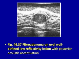 • Fig. 46.37 Fibroadenoma-an oval well-
defined low reflectivity lesion with posterior
acoustic accentuation.
 
