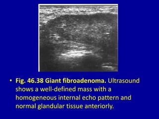 • Fig. 46.38 Giant fibroadenoma. Ultrasound
shows a well-defined mass with a
homogeneous internal echo pattern and
normal glandular tissue anteriorly.
 