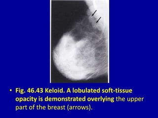 • Fig. 46.43 Keloid. A lobulated soft-tissue
opacity is demonstrated overlying the upper
part of the breast (arrows).
 