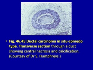 • Fig. 46.45 Ductal carcinoma in situ-comedo
type. Transverse section through a duct
showing central necrosis and calcification.
(Courtesy of Dr S. Humphreys.)
 