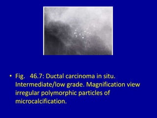 • Fig. 46.7: Ductal carcinoma in situ.
Intermediate/low grade. Magnification view
irregular polymorphic particles of
microcalcification.
 