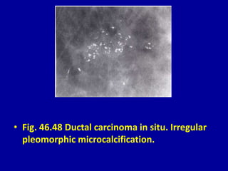 • Fig. 46.48 Ductal carcinoma in situ. Irregular
pleomorphic microcalcification.
 