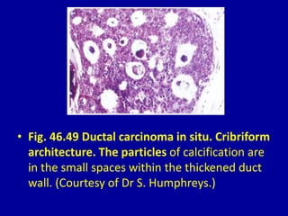 • Fig. 46.49 Ductal carcinoma in situ. Cribriform
architecture. The particles of calcification are
in the small spaces within the thickened duct
wall. (Courtesy of Dr S. Humphreys.)
 