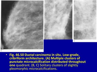 • Fig. 46.50 Ductal carcinoma in situ. Low-grade,
cribriform architecture. (A) Multiple clusters of
punctate microcalcification distributed throughout
one quadrant. (B, C) Solitary clusters of slightly
pleomorphic microcalcifications.
 