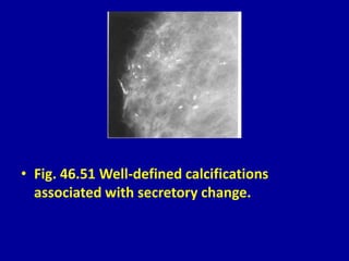 • Fig. 46.51 Well-defined calcifications
associated with secretory change.
 