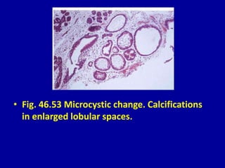 • Fig. 46.53 Microcystic change. Calcifications
in enlarged lobular spaces.
 