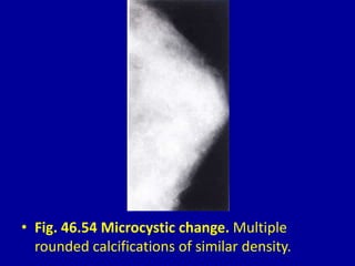 • Fig. 46.54 Microcystic change. Multiple
rounded calcifications of similar density.
 