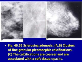 • Fig. 46.55 Sclerosing adenosis. (A,B) Clusters
of fine granular pleomorphic calcifications.
(C) The calcifications are coarser and are
associated with a soft tissue opacity.
 