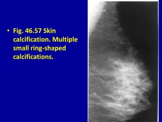 • Fig. 46.57 Skin
calcification. Multiple
small ring-shaped
calcifications.
 