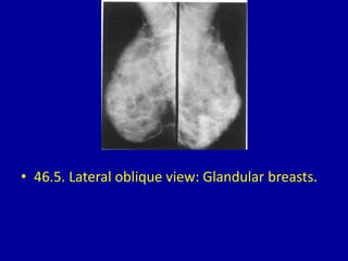 • 46.5. Lateral oblique view: Glandular breasts.
 