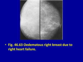 • Fig. 46.63 Oedematous right breast due to
right heart failure.
 