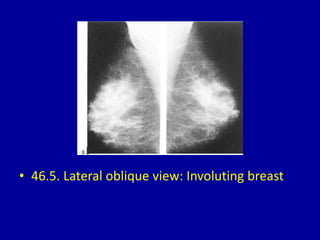 • 46.5. Lateral oblique view: Involuting breast
 