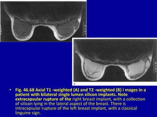 • Fig. 46.68 Axial T1 -weighted (A) and T2 -weighted (B) i mages in a
patient with bilateral single lumen silicon implants. Note
extracapsular rupture of the right breast implant, with a collection
of silicon lying in the lateral aspect of the breast. There is
intracapsular rupture of the left breast implant, with a classical
linguine sign.
 