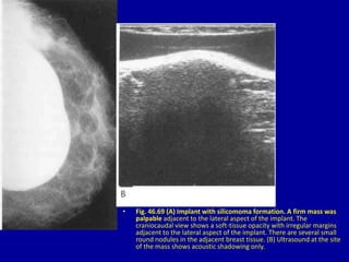 • Fig. 46.69 (A) Implant with silicomoma formation. A firm mass was
palpable adjacent to the lateral aspect of the implant. The
craniocaudal view shows a soft-tissue opacity with irregular margins
adjacent to the lateral aspect of the implant. There are several small
round nodules in the adjacent breast tissue. (B) Ultrasound at the site
of the mass shows acoustic shadowing only.
 