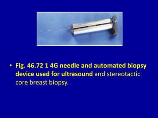 • Fig. 46.72 1 4G needle and automated biopsy
device used for ultrasound and stereotactic
core breast biopsy.
 