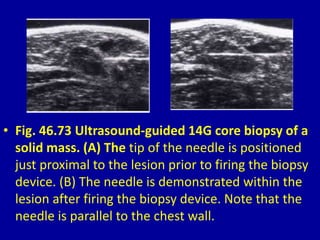 • Fig. 46.73 Ultrasound-guided 14G core biopsy of a
solid mass. (A) The tip of the needle is positioned
just proximal to the lesion prior to firing the biopsy
device. (B) The needle is demonstrated within the
lesion after firing the biopsy device. Note that the
needle is parallel to the chest wall.
 