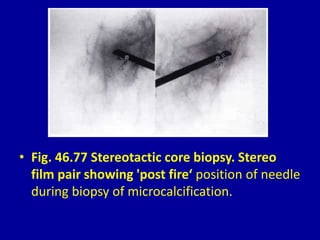 • Fig. 46.77 Stereotactic core biopsy. Stereo
film pair showing 'post fire‘ position of needle
during biopsy of microcalcification.
 