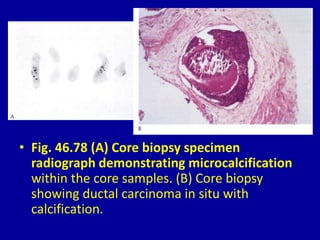 • Fig. 46.78 (A) Core biopsy specimen
radiograph demonstrating microcalcification
within the core samples. (B) Core biopsy
showing ductal carcinoma in situ with
calcification.
 