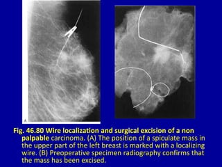 Fig. 46.80 Wire localization and surgical excision of a non
palpable carcinoma. (A) The position of a spiculate mass in
the upper part of the left breast is marked with a localizing
wire. (B) Preoperative specimen radiography confirms that
the mass has been excised.
 
