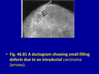• Fig. 46.81 A ductogram showing small filling
defects due to an intraductal carcinoma
(arrows).
 