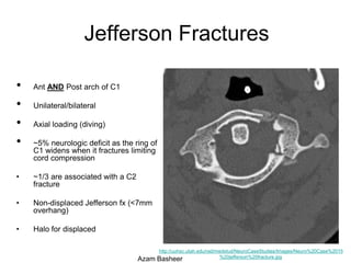 Upper C-spine Fractures Azam Basheer | PPTX