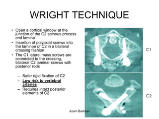 Upper C-spine Fractures Azam Basheer | PPTX